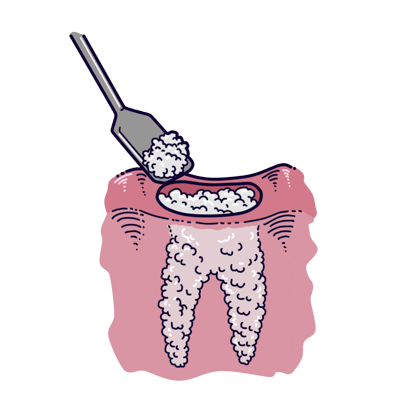 Bone Graft Mexico